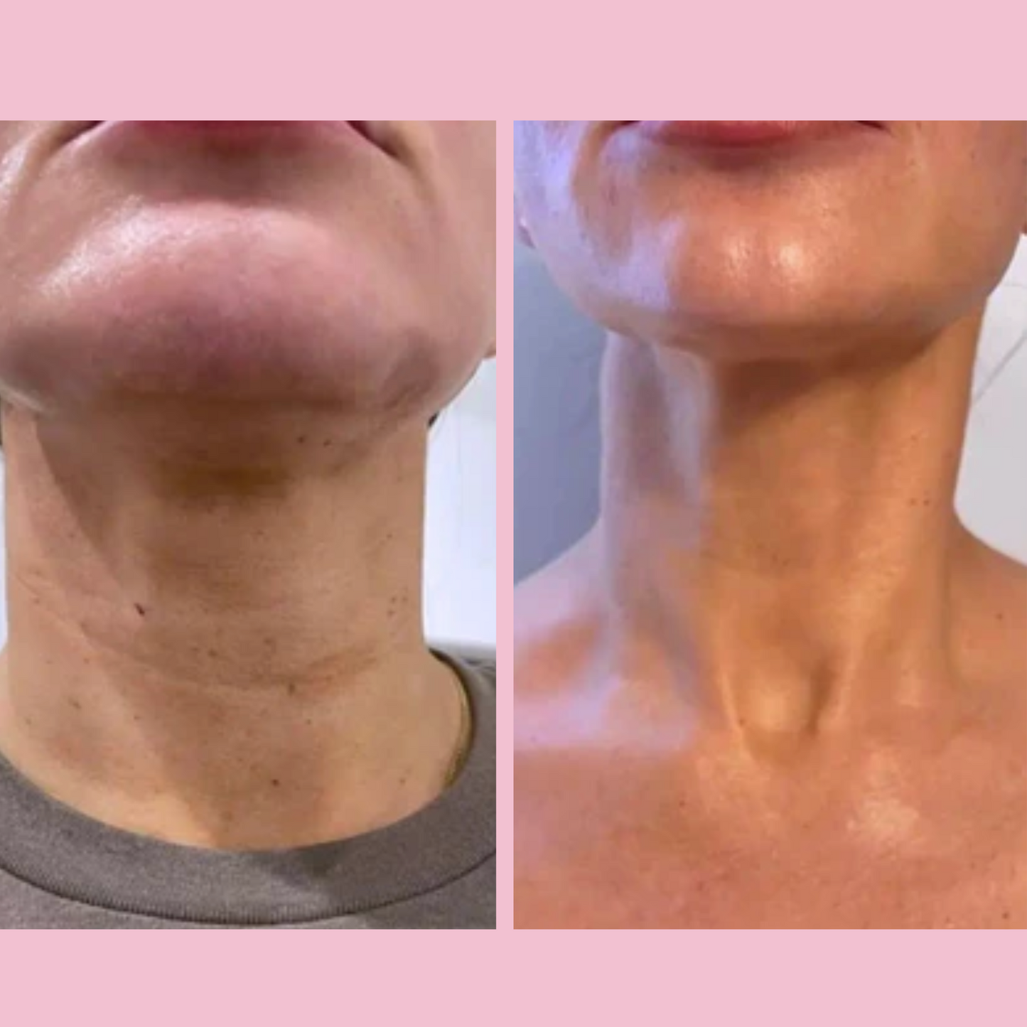 Microneedling Infusion Kit