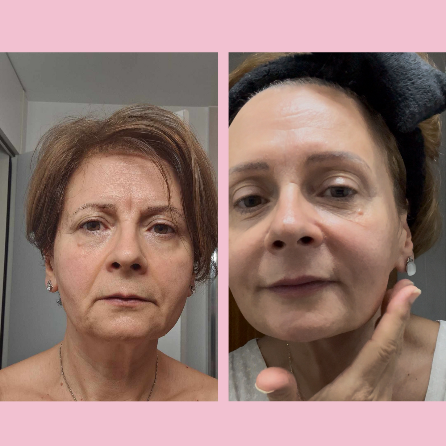 ANTI-RUGAS Microneedling Infusion Kit