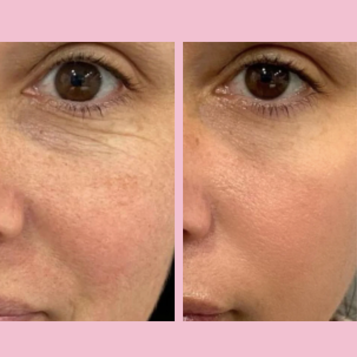 Microneedling Infusion Kit